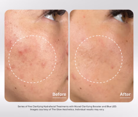Hydrafacial before and after example