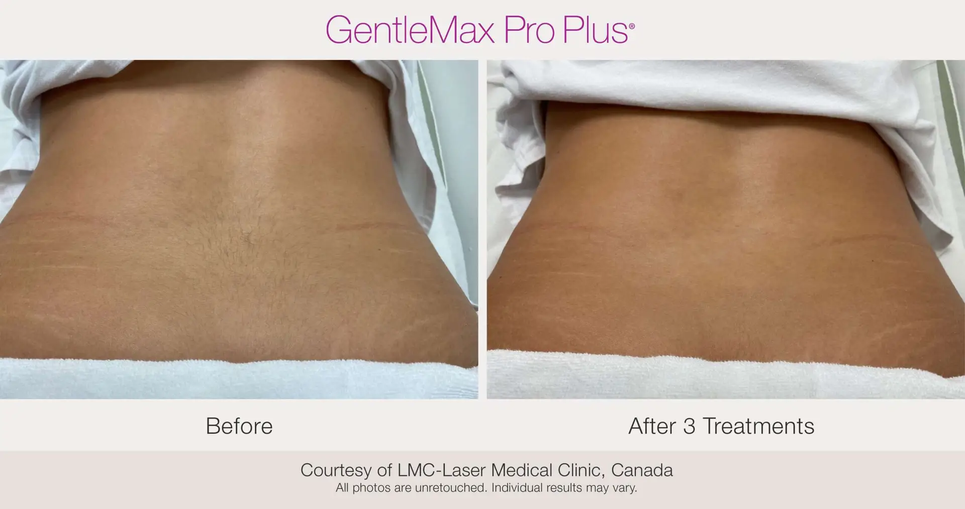 Laser Hair Removal before and after example
