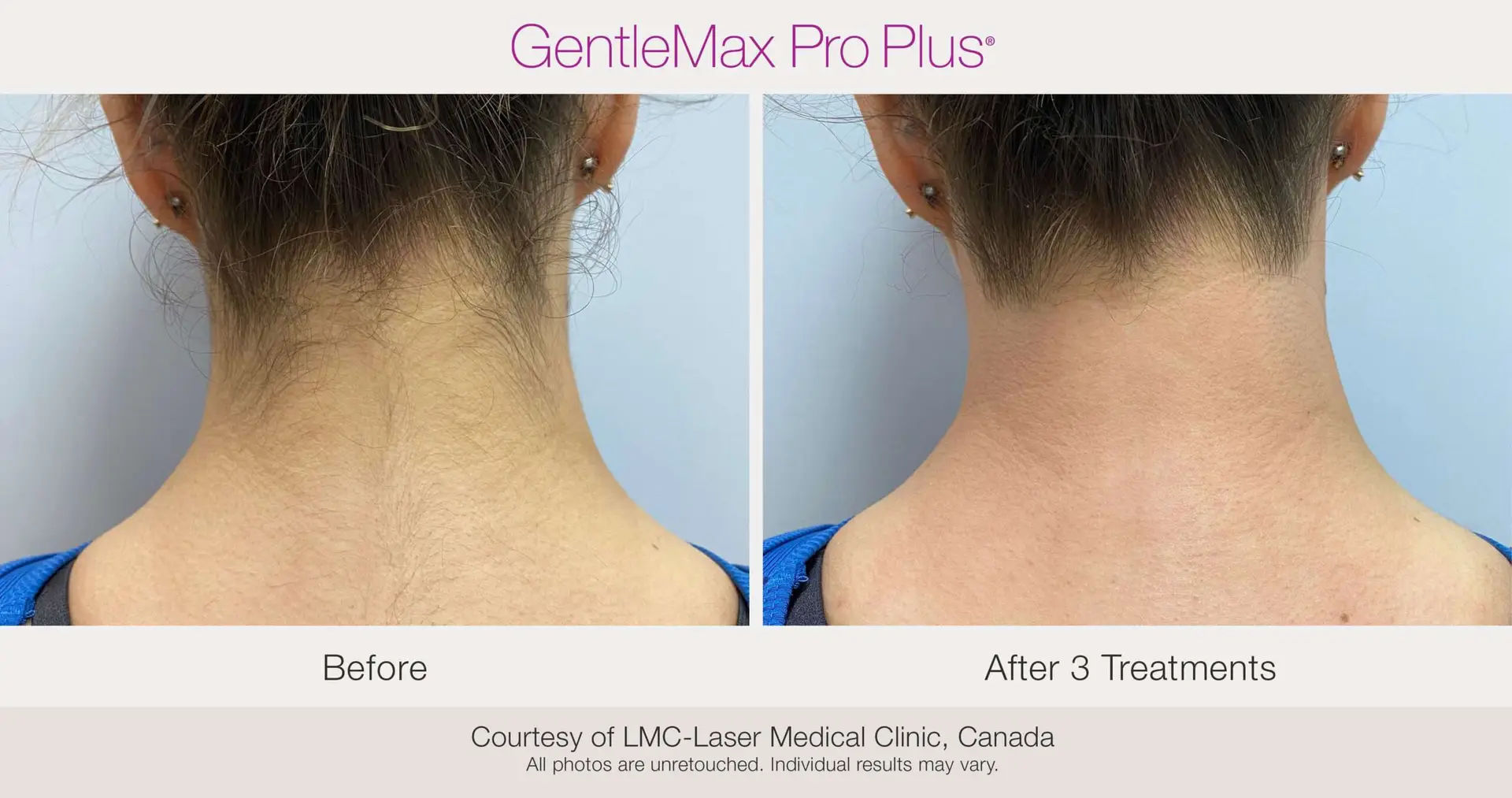Laser Hair Removal before and after example
