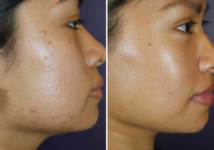 Microneedling before and after example